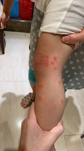 3歲幼童在公園玩耍卻被小黑蚊叮到全身多處紅腫,癢到小朋友受不了。圖/記者徐白櫻翻攝