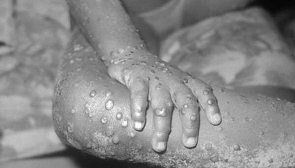 鑑於人們對「猴痘」（Monkeypox）的名稱具有污名化和種族主義的擔憂，世界衛生組織（WHO）正在考慮對其進行正式更名。