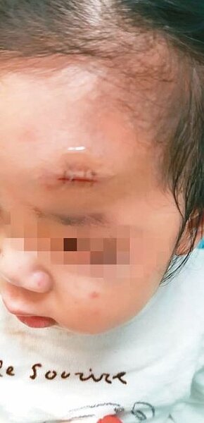 台南市1名2歲女童在水交社文化園區跌倒,額頭撞到鐵片縫了4、5針。圖/台南市議員周麗津提供