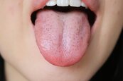 咬破舌頭卻痛好久？醫警告：血泡超過10天恐是重症徵兆
