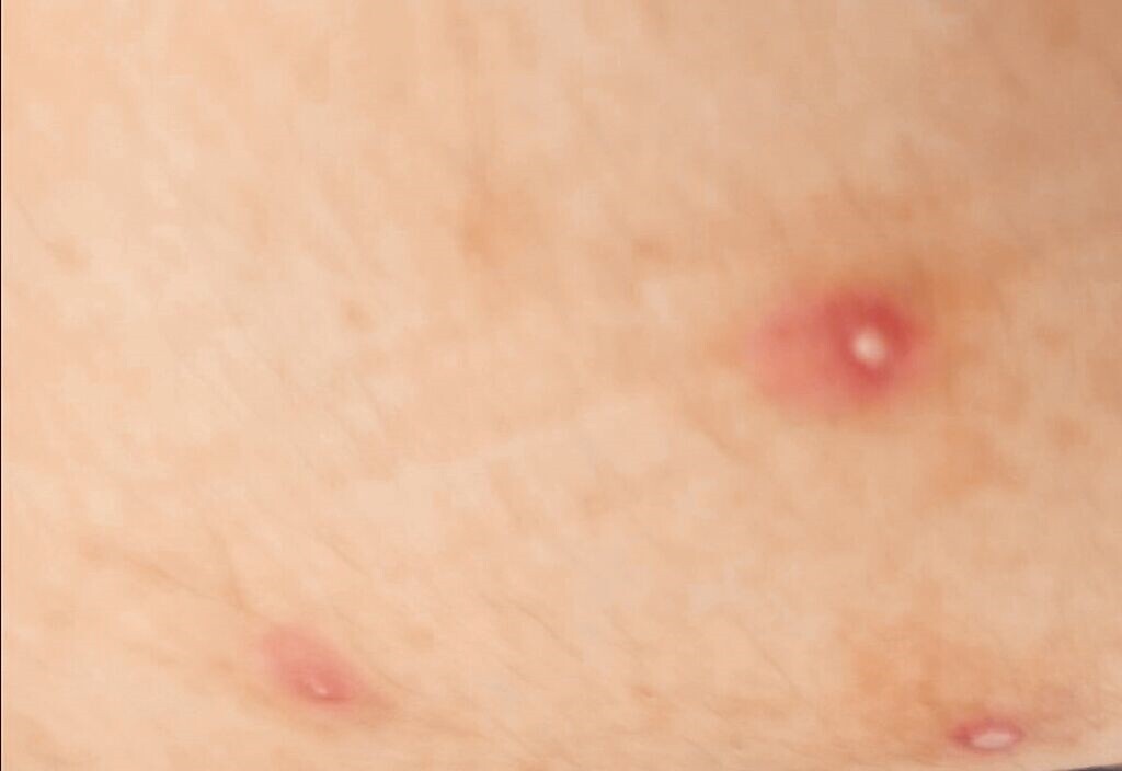 台南市政府衛生局25日公布猴痘患者大腿病灶照片,與海外感染者情況不甚相似。(台南市政府衛生局提供/程炳璋台南傳真)