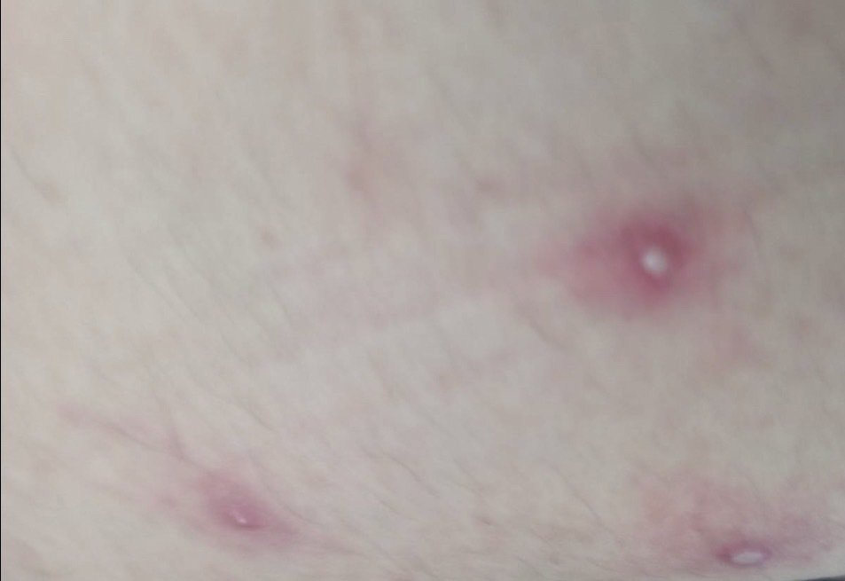 國內出現首例的境外移入猴痘病例,引發關注,圖為患者長在大腿上的水泡。圖/台南市衛生局提供