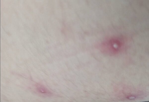 國內出現首例的境外移入猴痘病例,引發關注,圖為患者長在大腿上的水泡。圖/台南市衛生局提供