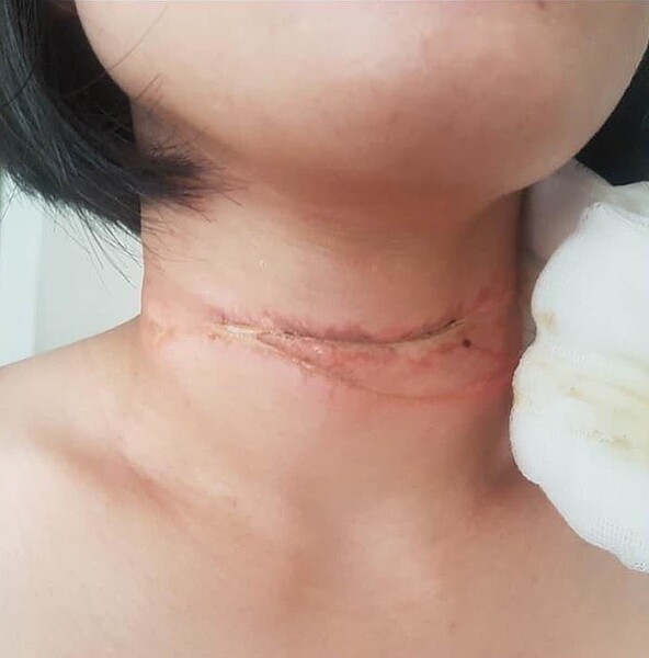 詹姓女騎士,上個月行經南區1處重劃區,脖子遭風箏線勒住,當場造成詹女頸部受傷。圖/市議員羅廷瑋提供