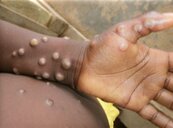 世衛宣布　猴痘列為「國際關注公共衛生緊急事件」