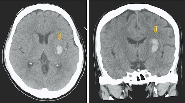 寒流來襲,氣溫驟降容易引發血管收縮,急診出現不少急性腦中風患者,經腦部斷層檢查後,發現腦部組織有白影(出血處)。(土城醫院提供)