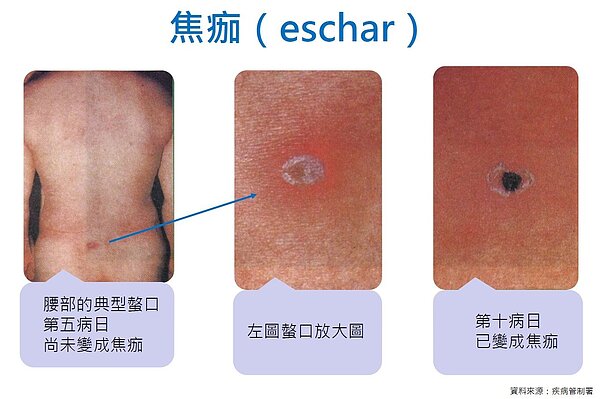 恙蟲病將導致患者高燒、頭痛、淋巴結腫大等症狀,桃園市衛生局提醒民眾掃墓要小心。圖/桃園市衛生局提供