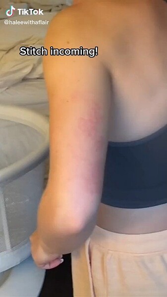 若被床蝨叮咬,會出現紅腫發癢、影響睡眠等症狀。圖/擷自抖音