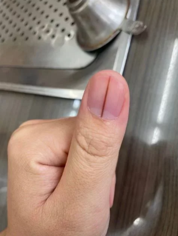 有網友大拇指指甲中央上長出一條深色的直線，多人勸他快就醫。圖／Dcard