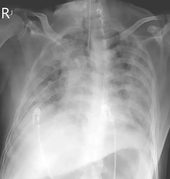 蘇一峰PO出一名大陸台商「大白肺」X光片,該名患者已嚴重肺炎,現在插管病危。圖/取自蘇一峰臉書