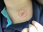 每3人就有1人罹患「皮蛇」　慢性病患風險高