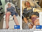 度假返家腿腫成3倍大誤認扭傷　女子感染「食肉細菌」險沒命