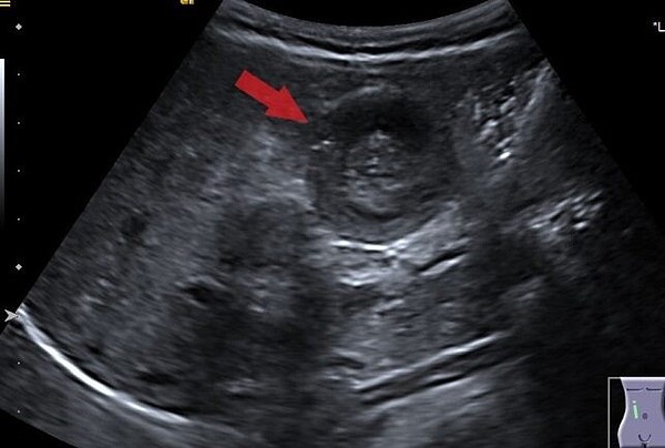 間歇性腹痛小心「腸套疊」惹禍。圖/北市聯醫忠孝院區提供