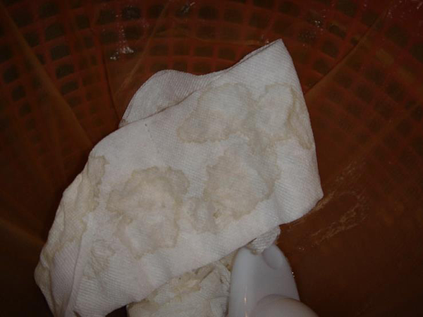 高峰診所院長高偉峰說，高山肺水腫案例咳出粉紅色泡泡痰，也就是淡淡的血痰。圖／高偉峰醫師提供