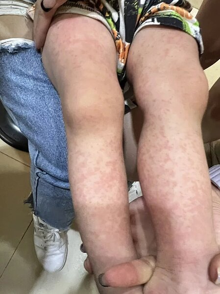 兒科醫師施勝桓說,5種病毒正流行,今天診間以腸病毒中的手足口症最多。圖/施勝桓提供