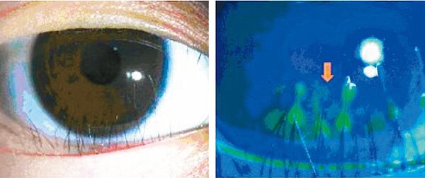 睫毛刺眼的傷害。圖/蔡傑智提供