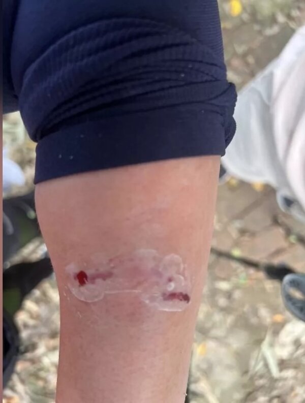 網友昨爬山遭猴子攻擊，左前臂有深深血齒痕。圖／翻攝臉書社團高雄大小事
