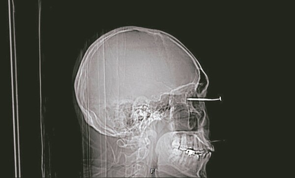 醫院檢查發現鐵釘貫穿男子的眼球,造成眼角膜、水晶體、玻璃體、視網膜、脈絡膜、鞏膜等眼部組織受損。圖/高醫提供