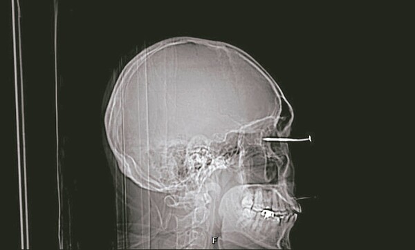 醫院檢查發現鐵釘貫穿男子的眼球，造成眼角膜、水晶體、玻璃體、視網膜、脈絡膜、鞏膜等眼部組織受損。圖／高醫提供