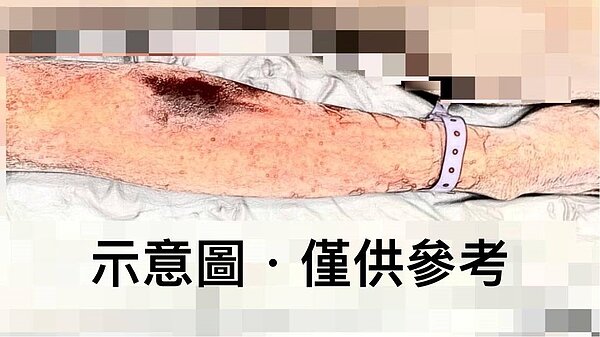 高大成分享,在他法醫生涯裡,卻未曾見過從10樓墜落,而只有手肘處的閉鎖性骨折,一般的墜樓尤其是10樓左右的高度,大都是開放性骨折,甚至連頭骨都會破裂,至今仍讓他百思不解。圖/高大成臉書