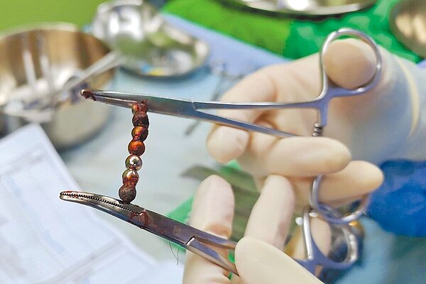 醫院透過微創手術的方式,順利將巴克球從男童的腸道內取出。(天主教輔仁大學附設醫院提供/呂健豪新北傳真)