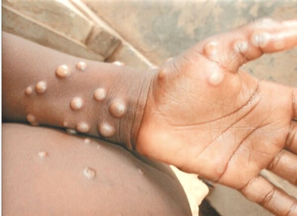 去年5月英國出現全球首例猴痘本土個案，症狀與天花相似，發燒1到3天後出現皮膚病灶。現在，台灣也爆出首例兒童猴痘，住院治療中。（圖取自世界衛生組織）
