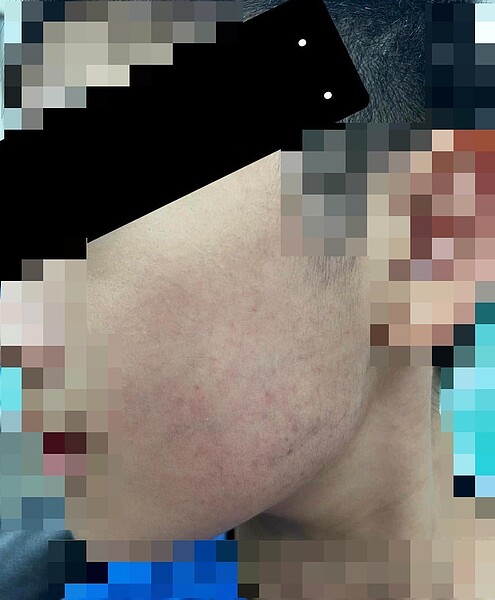 小孩的生母表示,照片為遭前夫家暴的兒子事發隔天在警局所拍攝,傷勢並不是輕微紅腫,是整片瘀青。圖/取自「嘎老師Miss Ga」臉書粉專