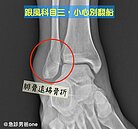 尾牙別再跳「科目三」！急診醫示警危險動作：嚴重恐骨折