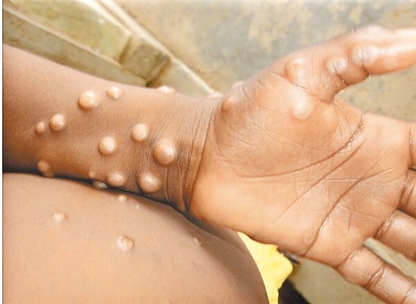 疾管署19日公告修正「傳染病分類」,將「猴痘」改稱為「M痘」。(取自世界衛生組織)