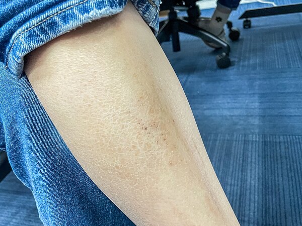 皮膚科醫師指出，近期乾燥性皮膚炎病人增加2至3成，主要為年長者和異位性皮膚炎患者。示意圖非當事人，記者賴昀岫／攝影 