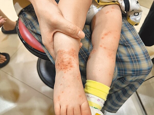 台中兒科門診近來遇到多例嬰幼兒感染腸病毒,四肢出現水泡與疹子,症狀比以往腸病毒感染嚴重,不少家長也同時被感染。圖/醫師施勝桓提供