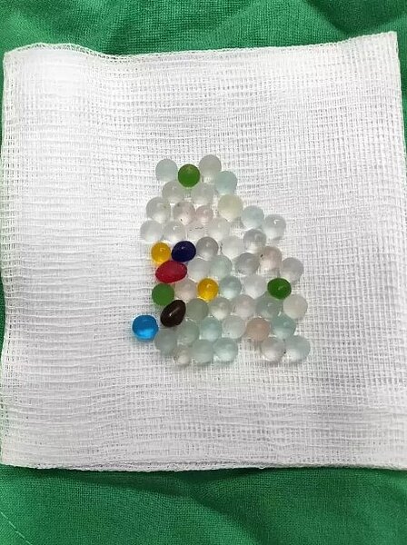 泌尿科醫師呂謹亨分享,有患者自行入珠了51顆,影響夫妻性生活。圖/呂謹亨提供