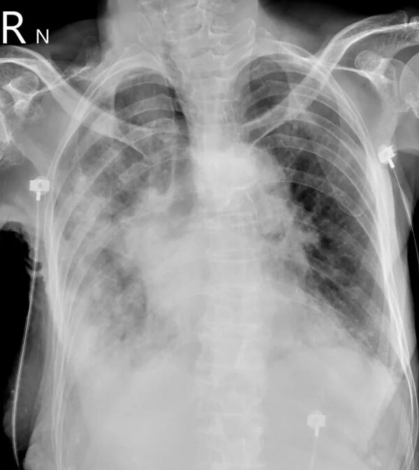 蘇一峰在臉書PO出一張患者「大白肺」X光片，他表示，目前看起來，新冠過年期間造成很多重症大白肺，「內科ICU有兩三成左右」。圖／取自蘇一峰臉書
