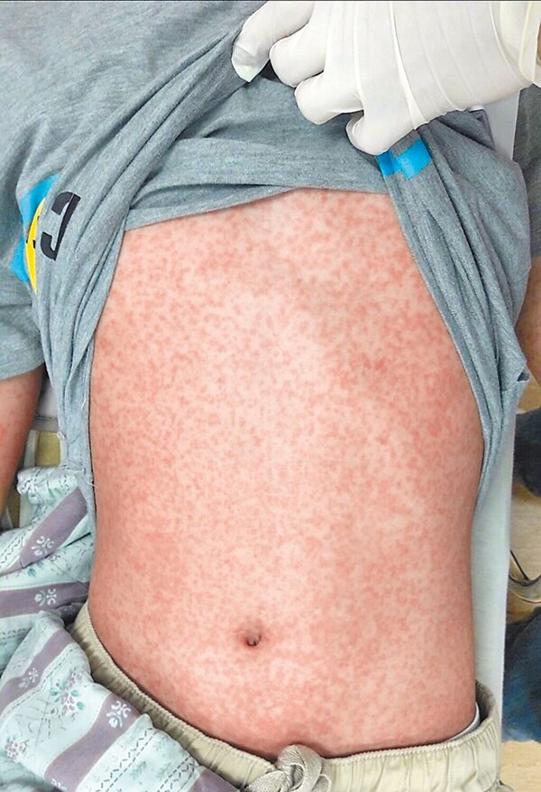 國內爆發今年首例本土麻疹病例！新北市36歲男性日前因持續發燒，4天內2度就醫，確診麻疹，緊急隔離，目前感染源不明。圖為麻疹症狀。（資料照片／賴佑維翻攝）