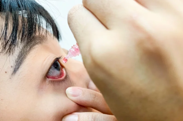 角膜受損、眼睛發炎的人，不建議自行購買使用涼感眼藥水。示意圖非新聞當事人，聯合報資料照片
