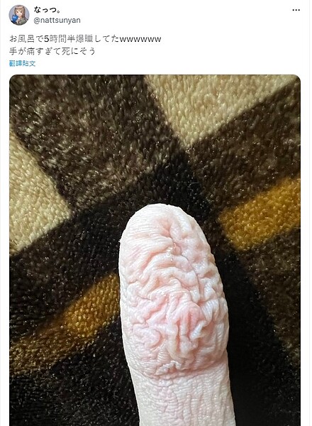 一位日本男大學生在浴缸裡睡了5個半小時,醒來後發現手指嚴重皺褶並且劇烈疼痛。 圖/擷取自X