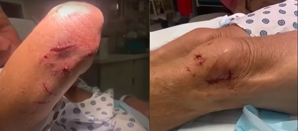 美國一男子在湖內游泳時遭水獺攻擊,全身有多達40幾處傷口。圖/擷自《KCRA 3》