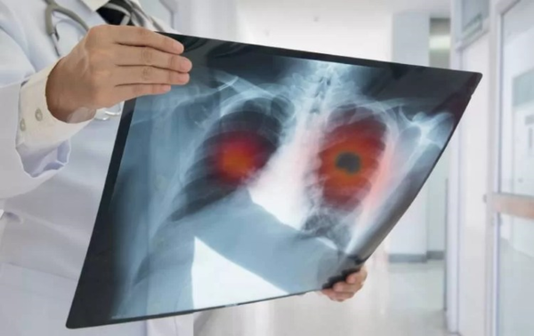 最新十大癌症出爐 肺癌躍升新癌王。(圖／Shutterstock)