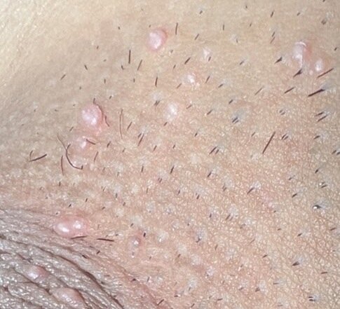 公共場所的毛巾若消毒不全，有可能成為「傳染性軟疣」（如圖）傳播的媒介。圖／本報系資料照片 