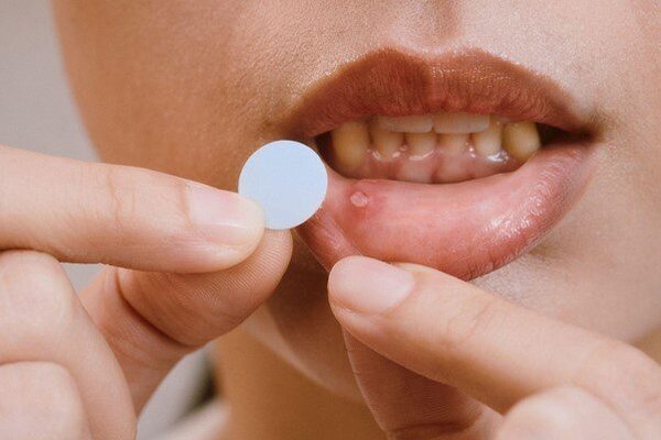 口內貼片產品的出現為嘴破患者提供更多舒緩的選擇（圖片來源：KingNet國家網路醫藥）