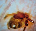 男童掃墓眼睛刺痛難耐　就醫取出發現竟是「恙蟲」