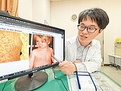 全球麻疹疫情升溫　醫籲打疫苗備戰