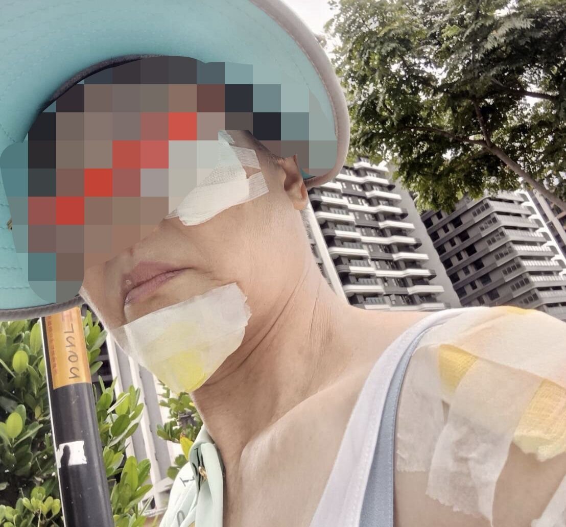 劉姓婦人臉部、下巴挫傷，肩膀也因此受傷導致無法抬起。圖：市議員余信憲辦公室提供