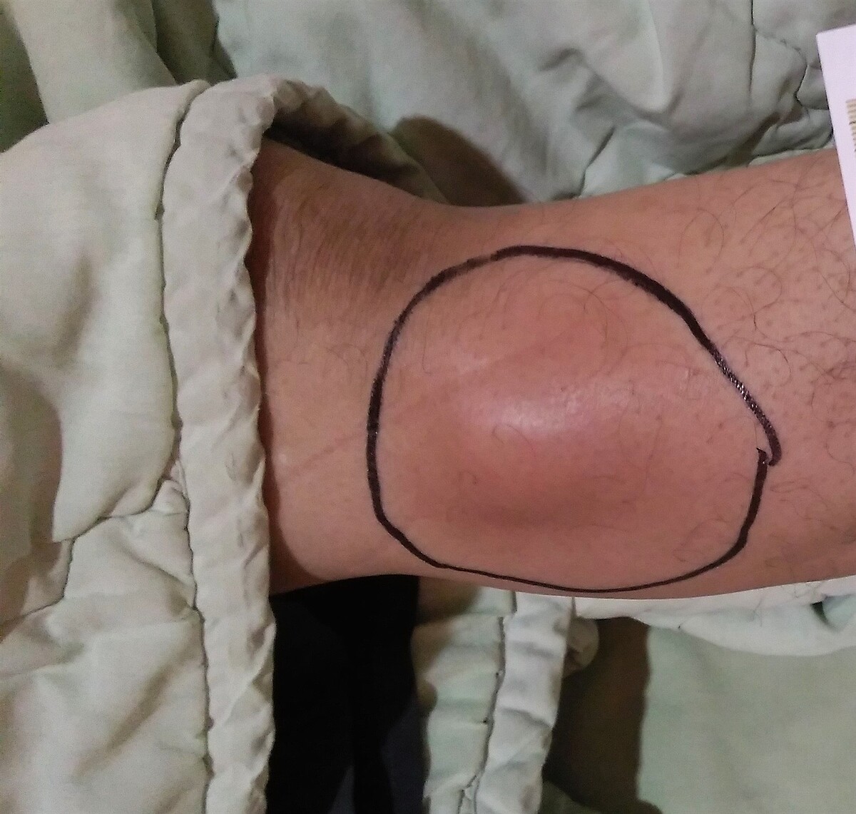 高雄市一名男病患右膝下外側出現皮膚腫塊且日益腫大,經細菌培養確診類鼻疽。圖/院方提供