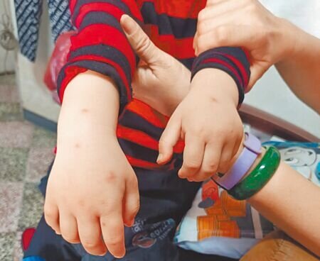 美濃居民邱先生說,看見2歲半的孫子全身被叮得滿是紅點,尤其頭部、手部腫脹嚴重,讓他十分擔憂。(林雅惠攝)