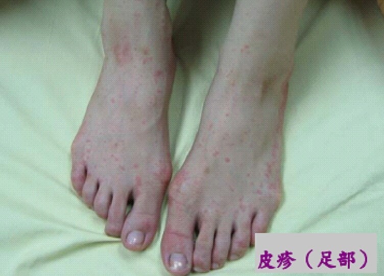 圖:衛福部疾管署提供