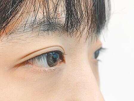 眼睛視網膜的細微變化,如微小的血管變形或出血,常與心臟病、中風等風險密切相關。(王家瑜攝)