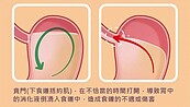 胃食道逆流已成常見疾病　苗栗衛生局解析4大類藥物作用