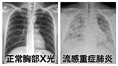 大S病逝「流感不是感冒」　杜承哲曝送醫徵兆、高危險群