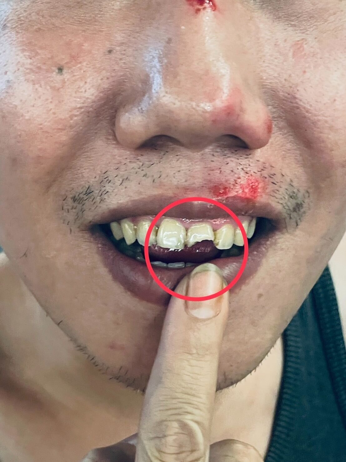 周男的人中、鼻樑、兩膝皆受到擦挫傷,其中一顆門牙更斷了一半。圖:截自黃瓊惠Threads